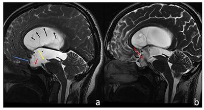 Idiopathic Aqueductal Stenosis: Late Neurocognitive Outcome in ETV Operated Adult Patients